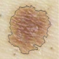 Skin Cancer Image Viewer